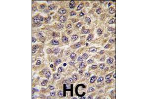 Formalin-fixed and paraffin-embedded human hepatocarcinoma tissue reacted with ILK Antibody (S246) , which was peroxidase-conjugated to the secondary antibody, followed by DAB staining. (ILK Antikörper  (AA 225-253))