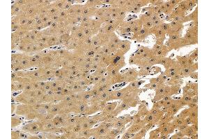 ABIN7093888 and ABIN7097931 at 1/100 staining human liver cancer and adjacent non-tumor tissue by IHC-P. (GSTO1 Antikörper  (N-Term))