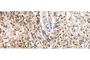 Immunohistochemistry of paraffin-embedded Human lung cancer tissue using CDT1 Polyclonal Antibody at dilution of 1:45(x200) (CDT1 Antikörper)