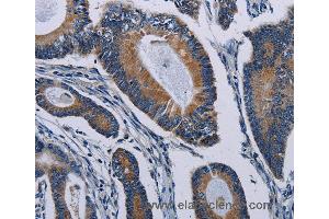 Immunohistochemistry of Human colon cancer using PCDHAC2 Polyclonal Antibody at dilution of 1:50 (PCDHAC2 Antikörper)