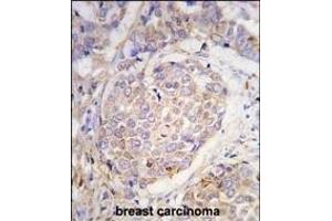 Forlin-fixed and paraffin-embedded hun breast carcino tissue reacted with GEA10 antibody (C-term) (ABIN390102 and ABIN2840614) , which was peroxidase-conjugated to the secondary antibody, followed by DAB staining. (MAGEA10 Antikörper  (C-Term))