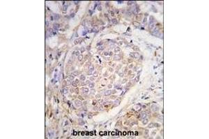 Forlin-fixed and paraffin-embedded hun breast carcino tissue reacted with GEA10 antibody (C-term) (ABIN390102 and ABIN2840614) , which was peroxidase-conjugated to the secondary antibody, followed by DAB staining.