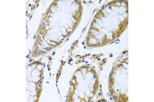 Immunohistochemistry of paraffin-embedded human colon carcinoma using FBXL5 antibody at dilution of 1:100 (x40 lens). (FBXL5 Antikörper)