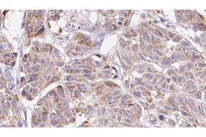 ABIN6276808 at 1/100 staining Human Melanoma tissue by IHC-P. (CCL4 Antikörper  (Internal Region))