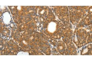 Immunohistochemistry of paraffin-embedded Human thyroid cancer using PRDX3 Polyclonal Antibody at dilution of 1:50 (Peroxiredoxin 3 Antikörper)