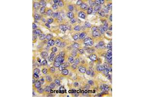 Formalin-fixed and paraffin-embedded human breast carcinoma tissue reacted with DKK3 polyclonal antibody  , which was peroxidase-conjugated to the secondary antibody, followed by DAB staining. (DKK3 Antikörper  (N-Term))