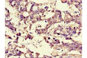 Immunohistochemistry of paraffin-embedded human gastric cancer using ABIN7159937 at dilution of 1:100 (BRP44 Antikörper  (AA 1-40))