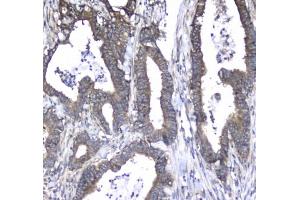 IHC testing of FFPE human colon cancer tissue with L1CAM antibody at 1ug/ml.