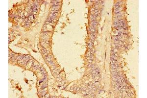 Immunohistochemistry of paraffin-embedded human endometrial cancer using ABIN7149414 at dilution of 1:100 (PLA2G4A Antikörper  (AA 379-533))