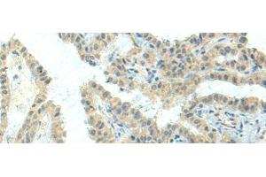Immunohistochemistry of paraffin-embedded Human thyroid cancer tissue using NPVF Polyclonal Antibody at dilution of 1:80(x200) (NPVF Antikörper)