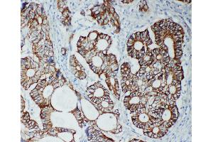 Anti-TJP2 antibody, IHC(P) IHC(P): Human Intestinal Cancer Tissue (TJP2 Antikörper  (C-Term))