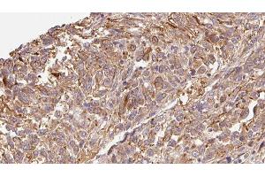 ABIN6279301 at 1/100 staining Human Melanoma tissue by IHC-P. (CMTM7 Antikörper  (Internal Region))
