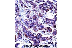 CASP6 Antibody (N-term) ((ABIN657756 and ABIN2846738))immunohistochemistry analysis in formalin fixed and paraffin embedded human bladder carcinoma followed by peroxidase conjugation of the secondary antibody and DAB staining. (Caspase 6 Antikörper  (N-Term))