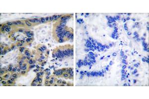 Cl-peptide - +Immunohistochemical analysis of paraffin-embedded human lung carcinoma tissue using Caspase 7 (cleaved-Asp198) antibody. (Caspase 7 Antikörper  (Cleaved-Asp198))