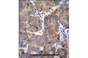 EIF3H Antibody immunohistochemistry analysis in formalin fixed and paraffin embedded human hepatocarcinoma followed by peroxidase conjugation of the secondary antibody and DAB staining. (EIF3H Antikörper  (N-Term))