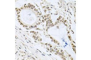 Immunohistochemistry of paraffin-embedded human gastric cancer using MCL1 antibody (ABIN5970080) at dilution of 1/100 (40x lens). (MCL-1 Antikörper  (C-Term))