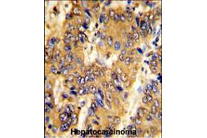 Formalin-fixed and paraffin-embedded human hepatocarcinoma with MSRB2 Antibody , which was peroxidase-conjugated to the secondary antibody, followed by DAB staining. (MSRB2 Antikörper  (AA 44-73))