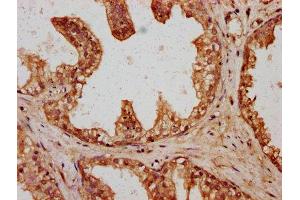 IHC image of ABIN7166723 diluted at 1:400 and staining in paraffin-embedded human prostate cancer performed on a Leica BondTM system.