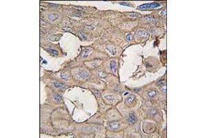 Formalin-fixed and paraffin-embedded human lung carcinoma tissue reacted with ANXA2 antibody (N-term), which was peroxidase-conjugated to the secondary antibody, followed by DAB staining. (Annexin A2 Antikörper  (N-Term))