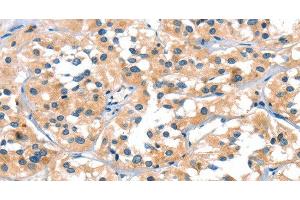 Immunohistochemistry of paraffin-embedded Human thyroid cancer tissue using SLC6A4 Polyclonal Antibody at dilution of 1:30 (SLC6A4 Antikörper)