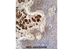 COL19A1 antibody (N-term) immunohistochemistry analysis in formalin fixed and paraffin embedded human skin carcinoma followed by peroxidase conjugation of the secondary antibody and DAB staining. (COL19A1 Antikörper  (Chain alpha 1, N-Term))