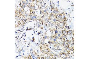 Immunohistochemistry of paraffin-embedded human breast cancer using R Rabbit pAb (ABIN3017320, ABIN3017321, ABIN3017322 and ABIN6220039) at dilution of 1:200 (40x lens). (RAMP2 Antikörper  (AA 1-145))