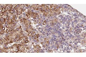 ABIN6279677 at 1/100 staining Human liver cancer tissue by IHC-P.
