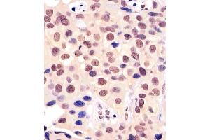 (ABIN6242199 and ABIN6577161) staining BANP in human breast carcinoma tissue sections by Immunohistochemistry (IHC-P - paraformaldehyde-fixed, paraffin-embedded sections). (BANP Antikörper  (AA 30-390))