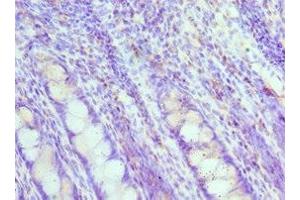 Immunohistochemistry of paraffin-embedded human colon cancer using ABIN7160088 at dilution of 1:100 (MAD2L1 Antikörper  (AA 1-205))