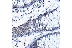 Immunohistochemistry of paraffin-embedded human colon using RPP25 Rabbit pAb (ABIN6133248, ABIN6147176, ABIN6147177 and ABIN6225317) at dilution of 1:100 (40x lens). (RPP25 Antikörper  (AA 1-199))