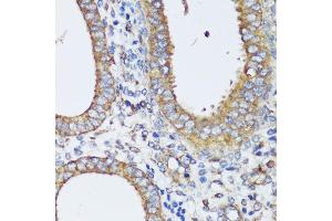 Immunohistochemistry of paraffin-embedded human uterine cancer using ERK1 / ERK2 antibody (ABIN7268619) at dilution of 1:200 (40x lens). (ERK1 Antikörper  (AA 200-300))