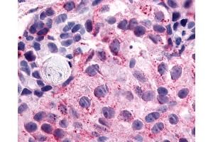 Anti-NPFFR1 / GPR147 antibody IHC of human Breast, Carcinoma. (NPFFR1 Antikörper  (C-Term))