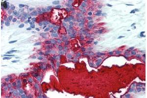 Human Breast (formalin-fixed, paraffin-embedded) stained with MUC1 antibody ABIN396912 at 5 ug/ml followed by biotinylated anti-mouse IgG secondary antibody ABIN481714, alkaline phosphatase-streptavidin and chromogen. (MUC1 Antikörper)