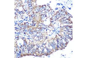 Immunohistochemistry of paraffin-embedded human colon carcinoma using IDH2 Rabbit mAb (ABIN7268028) at dilution of 1:100 (40x lens). (IDH2 Antikörper)