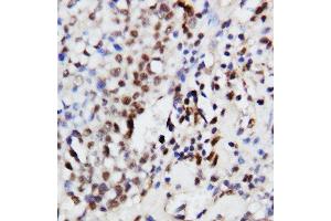Anti-ERK1 antibody, IHC(P) IHC(P): Human Mammary Cancer Tissue (ERK1 Antikörper  (Middle Region))