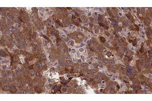 ABIN6277375 at 1/100 staining Human liver cancer tissue by IHC-P. (GLRA1 Antikörper  (Internal Region))