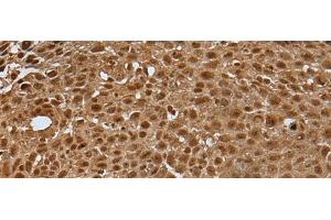 Immunohistochemistry of paraffin-embedded Human lung cancer tissue using LAMTOR5 Polyclonal Antibody at dilution of 1:35(x200) (HBXIP Antikörper)
