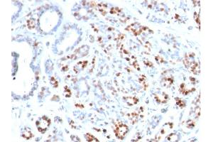 Formalin-fixed, paraffin-embedded human Breast Carcinoma stained with GATA-3 Mouse Monoclonal Antibody (GATA3/2444).