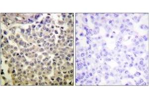 Immunohistochemistry analysis of paraffin-embedded human breast carcinoma, using PAK1/2/3 (Phospho-Thr423/402/421) Antibody. (PAK1/2/3 Antikörper  (pThr423))