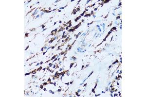 Immunohistochemistry of paraffin-embedded human breast cancer using SPN antibody (ABIN5973813) at dilution of 1/100 (40x lens). (CD43 Antikörper)