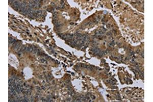 The image on the left is immunohistochemistry of paraffin-embedded Human colon cancer tissue using ABIN7129664(GSTO1 Antibody) at dilution 1/60, on the right is treated with fusion protein. (GSTO1 Antikörper)