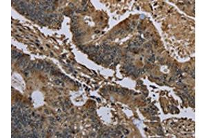 The image on the left is immunohistochemistry of paraffin-embedded Human colon cancer tissue using ABIN7129664(GSTO1 Antibody) at dilution 1/60, on the right is treated with fusion protein.