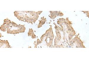 Immunohistochemistry of paraffin-embedded Human thyroid cancer tissue using HDHD2 Polyclonal Antibody at dilution of 1:40(x200)