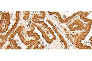 Immunohistochemistry of paraffin-embedded Human thyroid cancer tissue using GMEB2 Polyclonal Antibody at dilution of 1:35(x200) (GMEB2 Antikörper)
