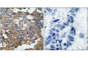 Immunohistochemistry analysis of paraffin-embedded human breast carcinoma tissue, using Src (Ab-529) Antibody. (Src Antikörper  (AA 487-536))