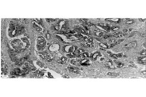 Immunohistochemical staining  of human gastric carcinoma tissue using MMP-3 antibody . (MMP3 Antikörper  (C-Term))