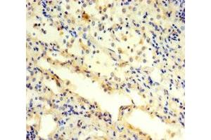 Immunohistochemistry of paraffin-embedded human lung cancer using ABIN7142230 at dilution of 1:100 (PSMC3 Antikörper  (Regulatory Subunit 6A))