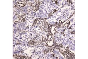 IHC testing of FFPE human lung cancer tissue with MVP antibody at 1ug/ml.