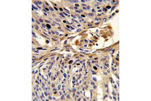 Formalin-fixed and paraffin-embedded human lung carcinoma reacted with APEX2 Antibody , which was peroxidase-conjugated to the secondary antibody, followed by DAB staining.