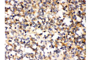 Anti- PAK5 Picoband antibody, IHC(P) IHC(P): Human Glioma Tissue